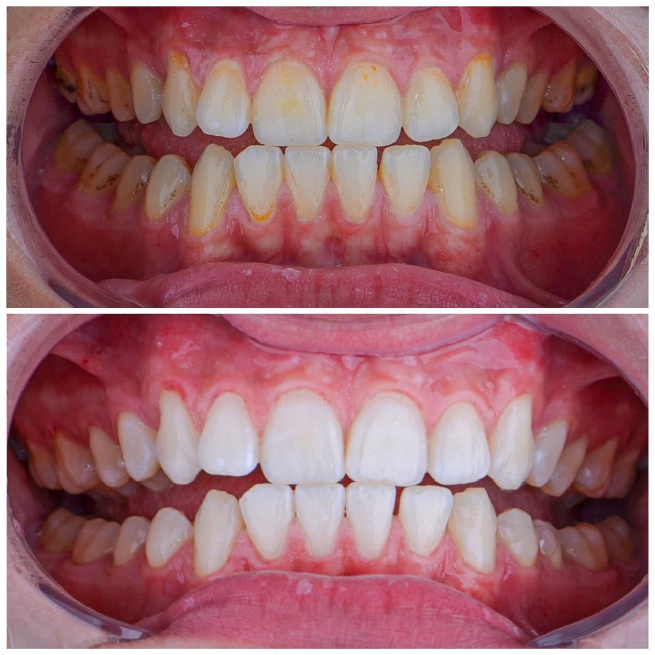 After Treatment Case 3