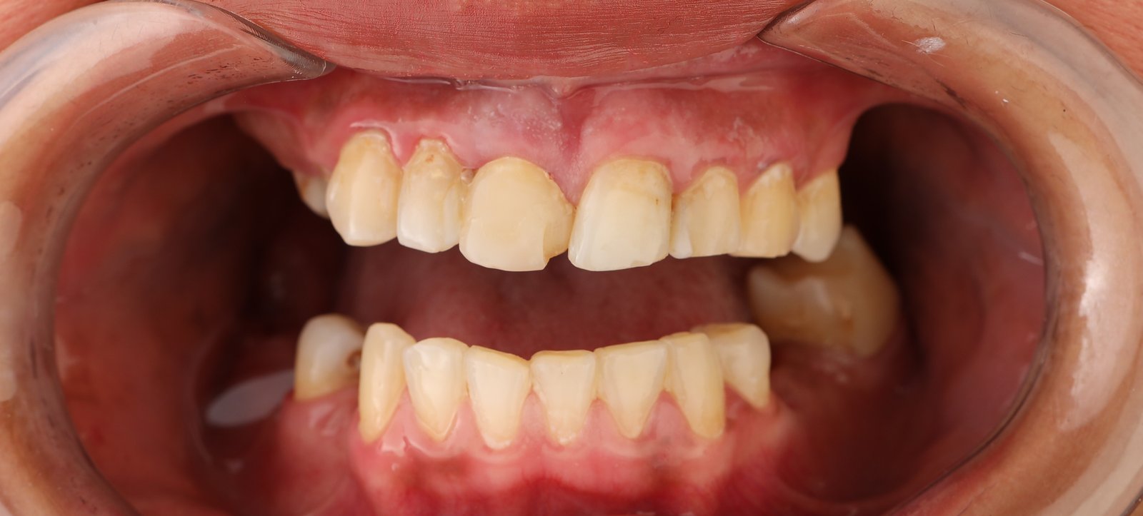 Before Treatment Zirconia