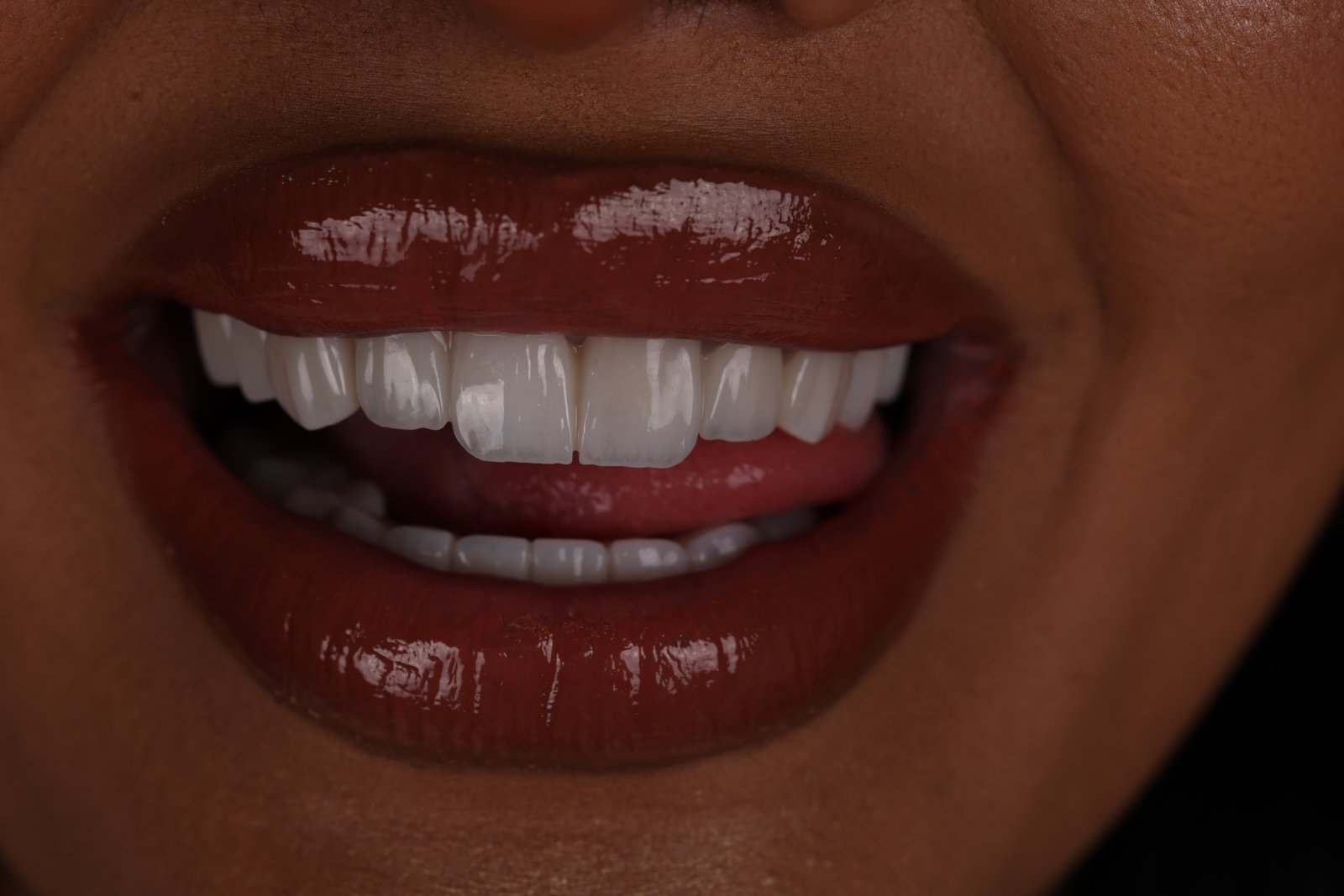 After Treatment Zirconia
